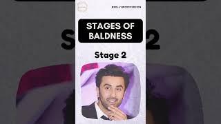 Stages of Baldness Feat. Bollywood Stars | Hair Transplant Clinic | Dadu Medical Centre Trichology