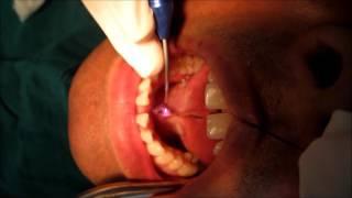 Lingual Frenectomy with Diode Laser