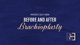 Brachioplasty Including Liposuction Post Weight Loss {Patient 2017-5000} Before & After