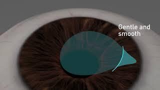 Eye laser correction: SmartSight lenticule extraction procedure with SCHWIND ATOS  femtosecond laser