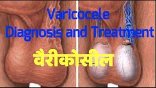 VARICOCELE - Symptoms, Causes and Treatment in  HINDI, Dr Santosh Agrawal