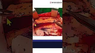 SMAS층을 당기는 안면거상 수술 - 제이제이성형외과#shorts