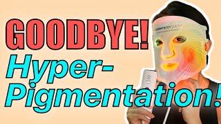 Improving my Hyperpigmentation! | *NEW* CurrentBody Skin 4-in-1 LED Face Mask | Kat L