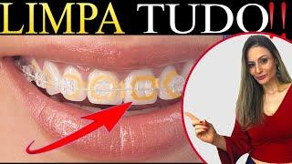 (KILLING TIP) Orthodontic device how to do hygiene and have white teeth!!!