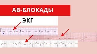 АВ-блокады. ЭКГ диагностика. Клинические примеры. Атриовентрикулярные блокады.