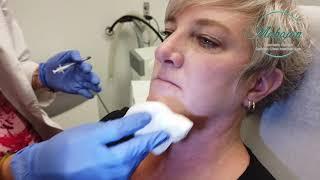 Botox for chin wrinkling and dimpling