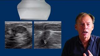 Ultrasound of the Breast - part 2