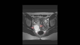 Pelvic pain in 20 year old female