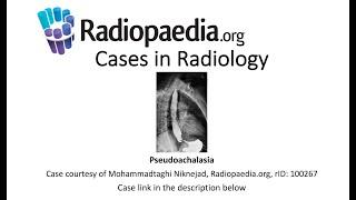 Pseudoachalasia (Radiopaedia.org) Cases in Radiology