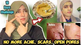 10 Days Challenge - No More ACNE, Pimples & Dark Spots + Get FAIR, Poreless Flawless Skin