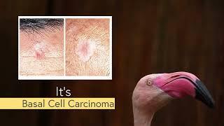 What's That? - Basal Cell Carcinoma