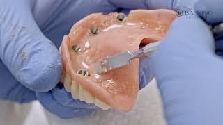 New Guided System Implants  at Banning Dental Group