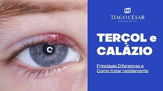 Terçol e Calázio | Quais as Diferenças? Como tratar? | Dr. Tiago César - oftalmologista