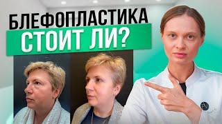 Что Такое Блефаропластика и Как Подготовиться к Операции?