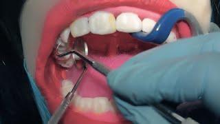 ASMR Dental Exam  Scaling & Cavities | Dentist & Patient POV