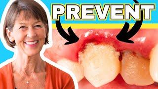 How To Treat Gingivitis And Gum Recession (At Home)