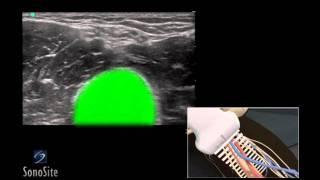 How to: Ultrasound Guided Peripheral Inserted Venous Catheter 3D Video