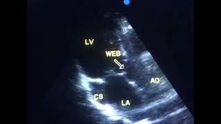 Sub aortic stenosis, is it a congenital heart disease? @ to drahmadmirdamadi?si=Ki_JIzZBvYvqoKkZ