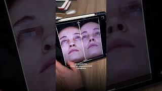 Уникальный случай ринопластики! Перфорация более 3 сантиметров