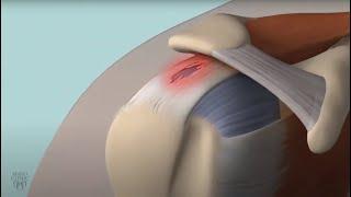 Learn About Rotator Cuff Damage