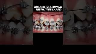 Time lapse of braces re-aligning crooked teeth #dentist #tooth #medical #health