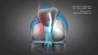 Patella Dysfunction