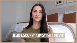 HAIR LOSS UPDATE | my hair loss and minoxidil update, my minoxidil experience, androgenic alopecia