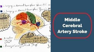 Middle Cerebral Artery Stroke