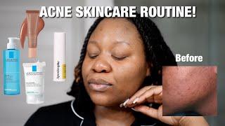 My Acne Journey: The Skincare That Actually Worked for Me ft. Apostrophe