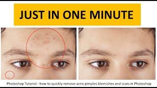 how to remove acne pimples or dark spots in photoshop | remove acne from photo photoshop tutorial