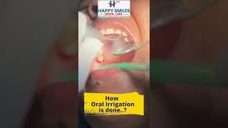 How Dental Irrigation Is Done..?  || Oral Hygiene || #shorts