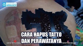 CARA HAPUS TATTO TANPA LASER DAN PERAWATANYA