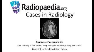 Rasmussen's encephalitis (Radiopaedia.org) Cases in Radiology