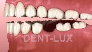Что происходит после удаления зуба?