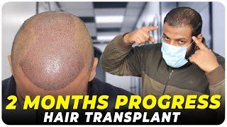 Hair Transplant in Bhopal | Best Results & Cost of Hair Transplant in Bhopal