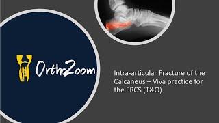 Intra-articular fracture of the calcaneus - viva practice for FRCS T&O