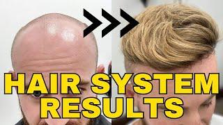 ULTIMATE BEFORE AND AFTER HAIR SYSTEM RESULTS (My First Two Systems) - Toupee / Wig / Replacement