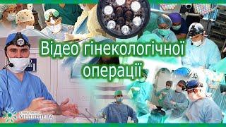 Старндартна лапароскопічна міомектомія, вузол 8 см