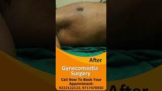 Gynecomastia Surgery result #short