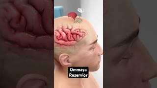 Injecting medicine directly into the brain (3D Animation)