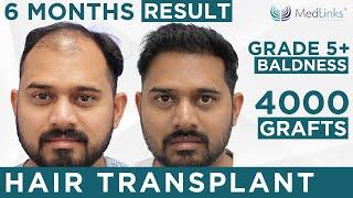 Amazing Hair Transplant Results at Medlinks in Delhi | Best Hair Transplant Surgeon in Delhi