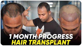 Hair Transplant in Bikaner | Best Results & Cost of Hair Transplant in Bikaner