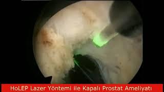 HoLEP Lazer Yöntemi ile Kapalı Prostat Ameliyatı - Üroloji Uzmanı Prof.Dr. Ayhan Karaköse