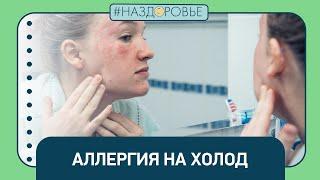 #НАЗДОРОВЬЕ: аллергия на холод