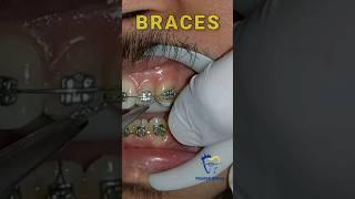 Braces / ligature wire to secure wire on bracket