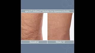 ageLOC WellSpa iO's Revitalize Routine - Demonstrated Results