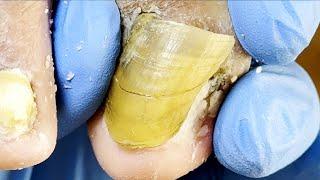 Strange Onychomycosis, Quick Treatment In Seconds!【Xue Yidao】