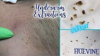 Underarm Extractions | HueVine