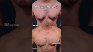 Male Chest Contouring | BEFORE and AFTER