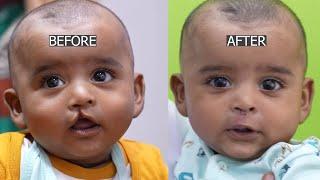Before and After Cleft lip Surgery Baby - Amazing Surgery Results & Journey